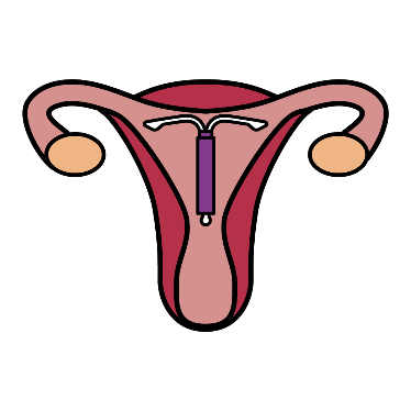 IUD inside a uterus